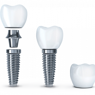 Плюси та мінуси імплантації зубів